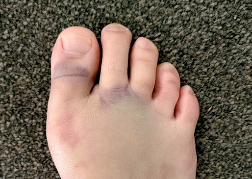 Julie's bruised foot